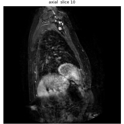 Animasjon gjennom MR-snitt med modellens segmentering for la 004